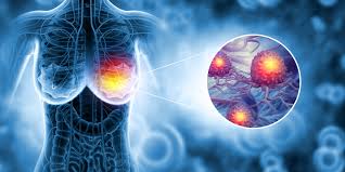 Hành trình chẩn đoán ung thư vú di căn